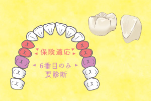 保険適応・下顎6番目のみ要診断