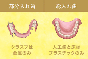 部分入れ歯（クラスプは金属のみ）総入れ歯（人工歯と床はプラスチックのみ）