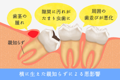 横に生えた親知らずによる悪影響…歯茎の腫れ・隙間に汚れがたまり虫歯に・周囲の歯並びが悪化